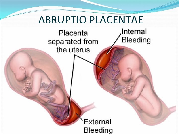 ABRUPTIO PLACENTAE 