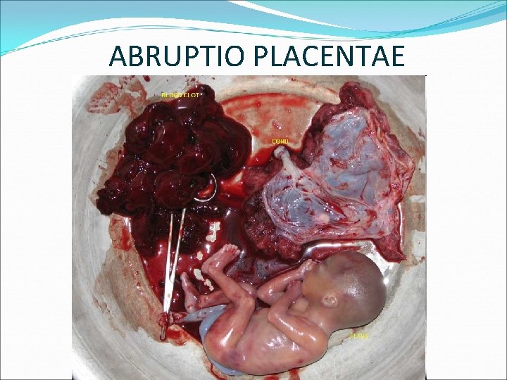 ABRUPTIO PLACENTAE 