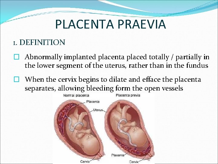 PLACENTA PRAEVIA 1. DEFINITION � Abnormally implanted placenta placed totally / partially in the