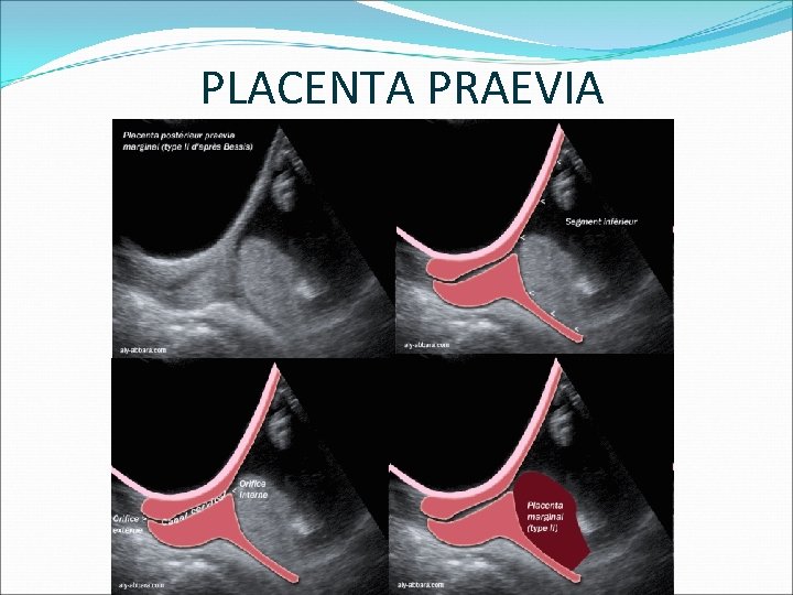 PLACENTA PRAEVIA 