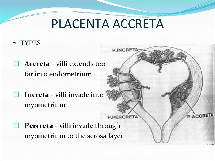 PLACENTA ACCRETA 2. TYPES � Accreta - villi extends too far into endometrium �