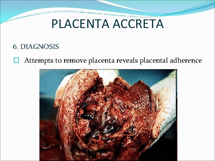 PLACENTA ACCRETA 6. DIAGNOSIS � Attempts to remove placenta reveals placental adherence 
