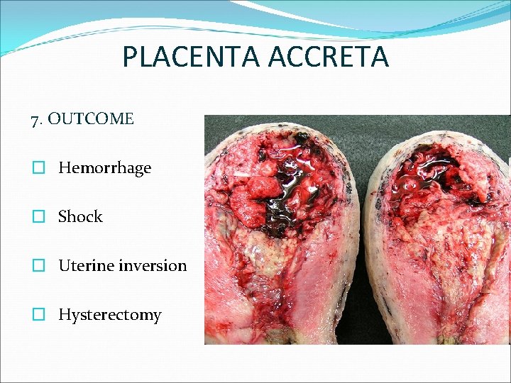 PLACENTA ACCRETA 7. OUTCOME � Hemorrhage � Shock � Uterine inversion � Hysterectomy 