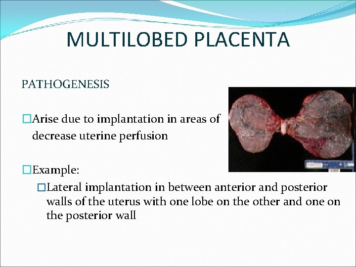 MULTILOBED PLACENTA PATHOGENESIS �Arise due to implantation in areas of decrease uterine perfusion �Example: