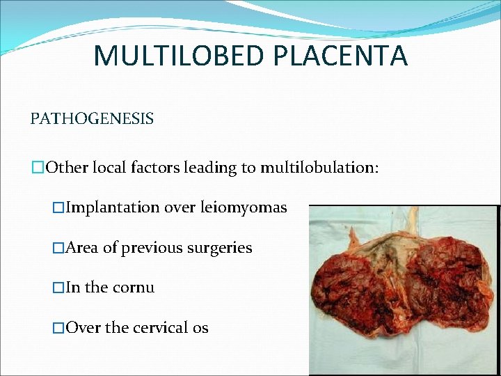 MULTILOBED PLACENTA PATHOGENESIS �Other local factors leading to multilobulation: �Implantation over leiomyomas �Area of