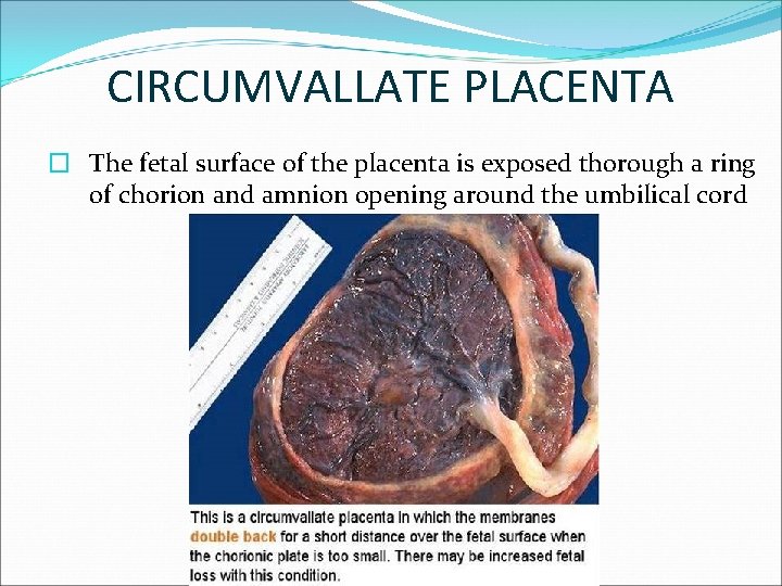 CIRCUMVALLATE PLACENTA � The fetal surface of the placenta is exposed thorough a ring