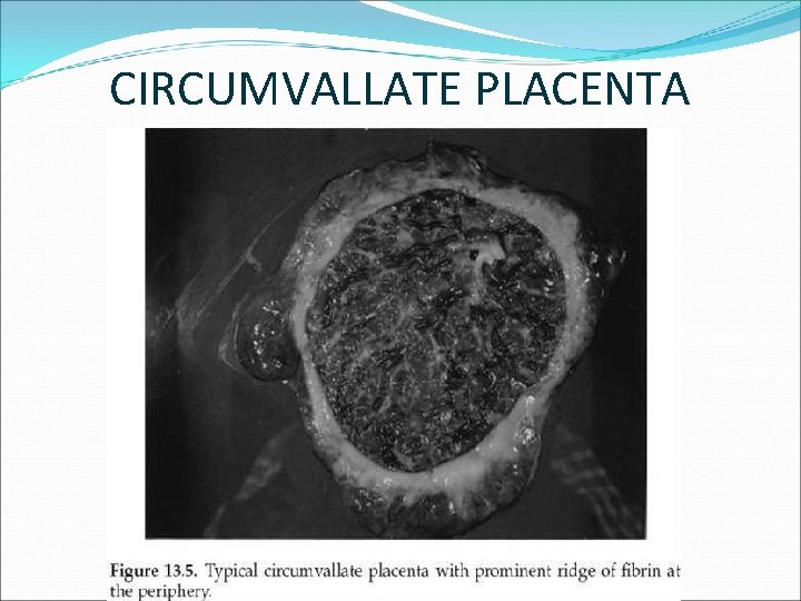 CIRCUMVALLATE PLACENTA 