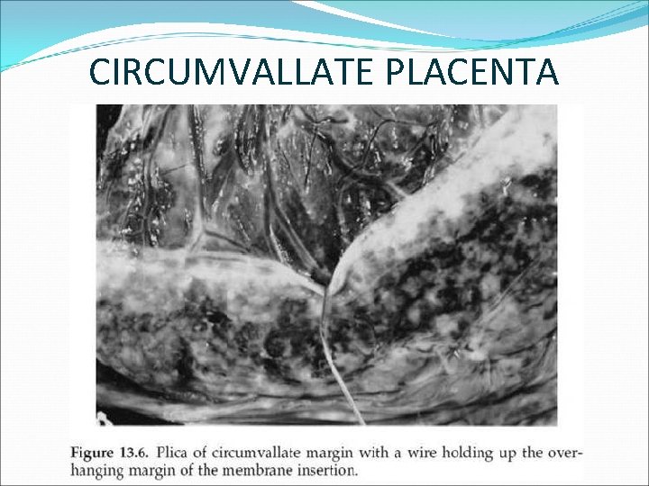 CIRCUMVALLATE PLACENTA 