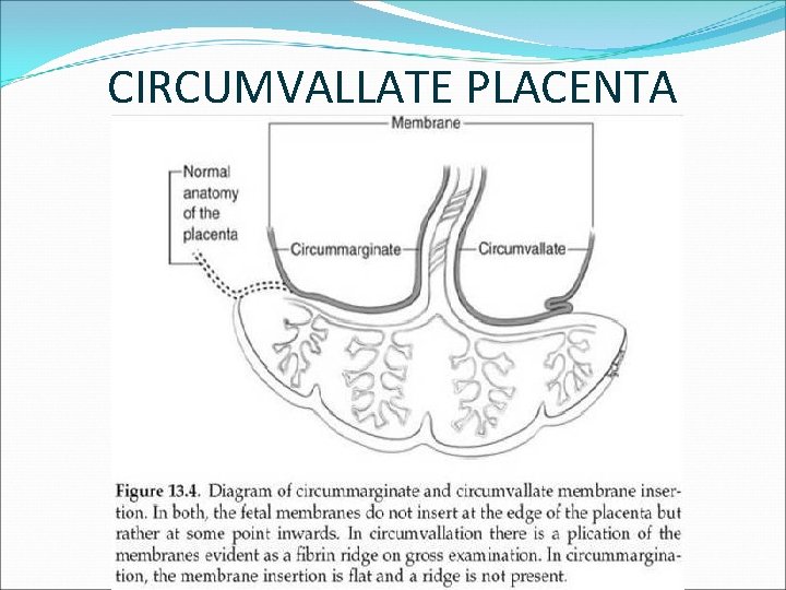 CIRCUMVALLATE PLACENTA 