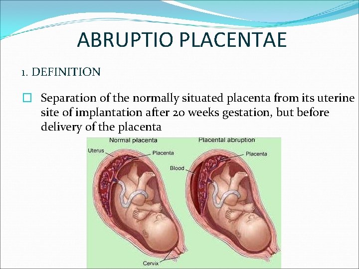 ABRUPTIO PLACENTAE 1. DEFINITION � Separation of the normally situated placenta from its uterine