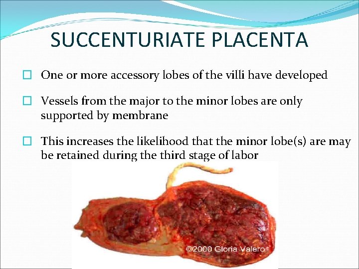 SUCCENTURIATE PLACENTA � One or more accessory lobes of the villi have developed �