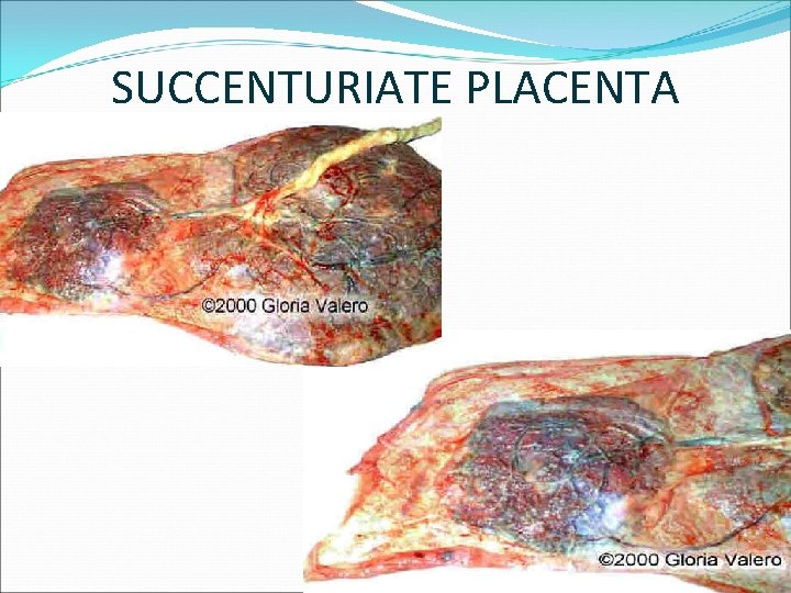 SUCCENTURIATE PLACENTA 