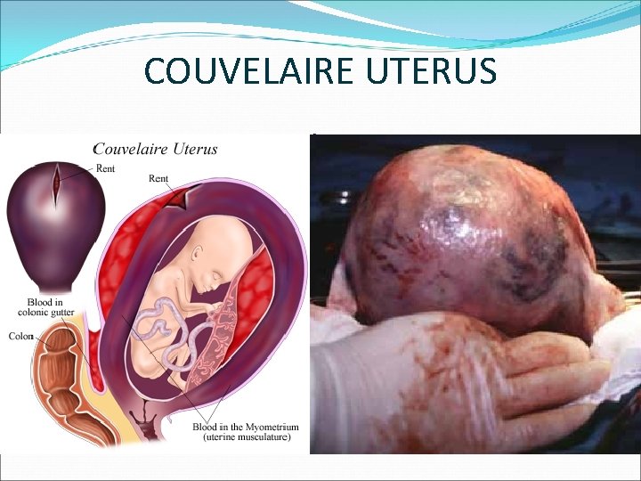 COUVELAIRE UTERUS 