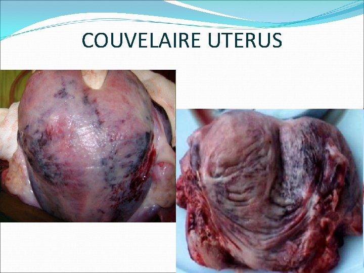 COUVELAIRE UTERUS 