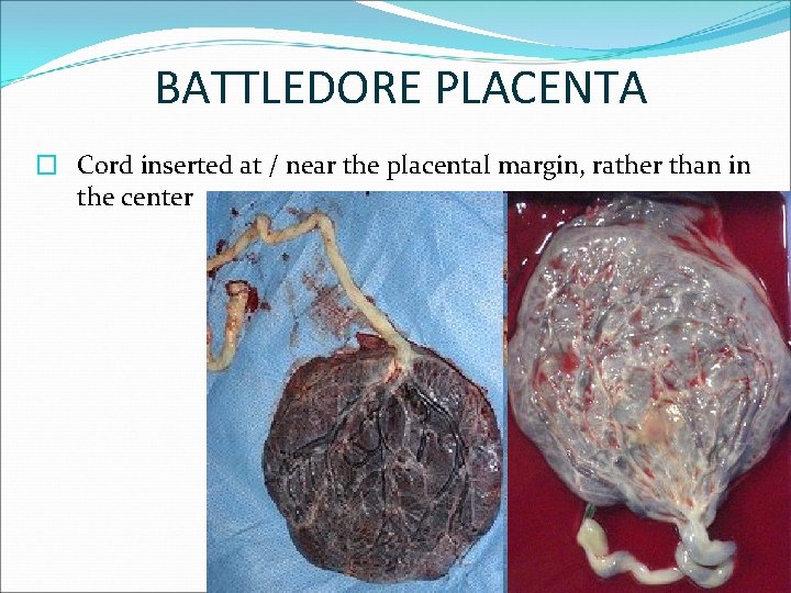 BATTLEDORE PLACENTA � Cord inserted at / near the placental margin, rather than in