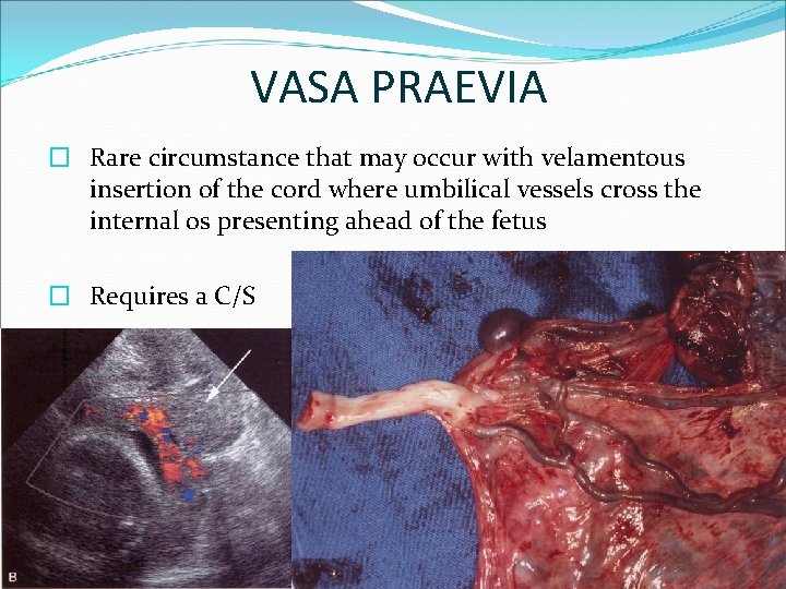 VASA PRAEVIA � Rare circumstance that may occur with velamentous insertion of the cord
