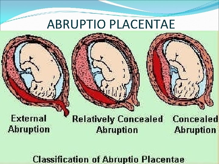 ABRUPTIO PLACENTAE 