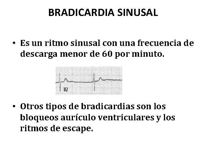 BRADICARDIA SINUSAL • Es un ritmo sinusal con una frecuencia de descarga menor de