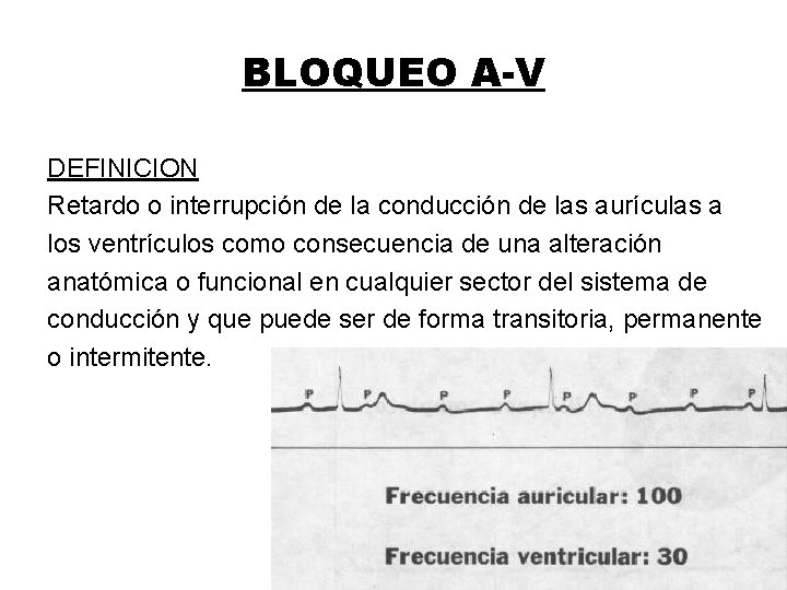 BLOQUEO A-V DEFINICION Retardo o interrupción de la conducción de las aurículas a los