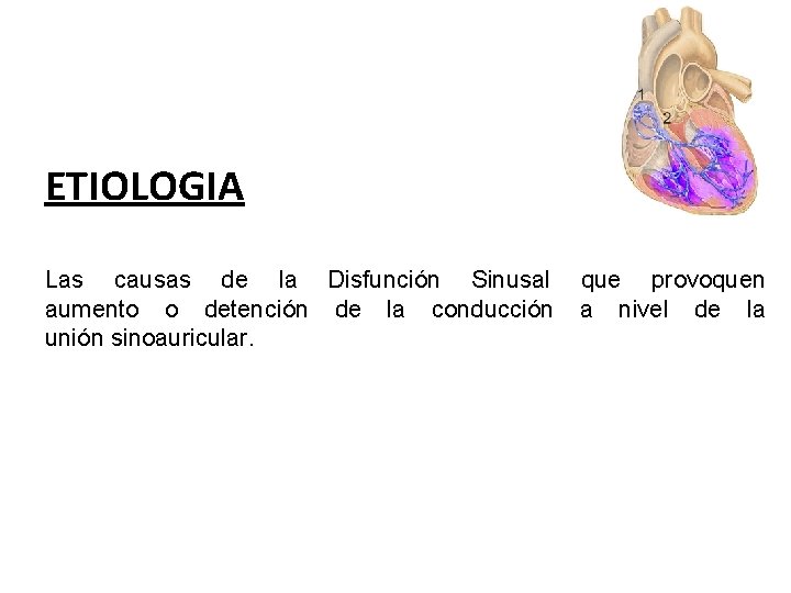 ETIOLOGIA Las causas de la Disfunción Sinusal aumento o detención de la conducción unión