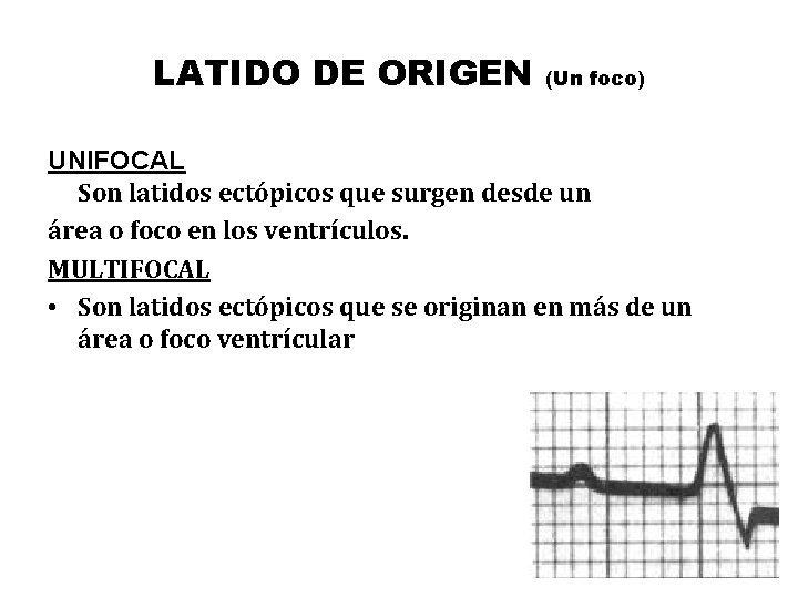 LATIDO DE ORIGEN (Un foco) UNIFOCAL Son latidos ectópicos que surgen desde un área