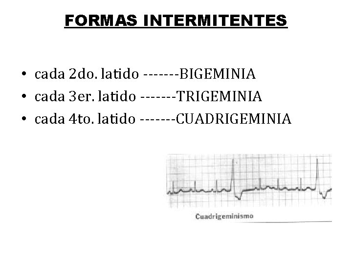 FORMAS INTERMITENTES • cada 2 do. latido -------BIGEMINIA • cada 3 er. latido -------TRIGEMINIA