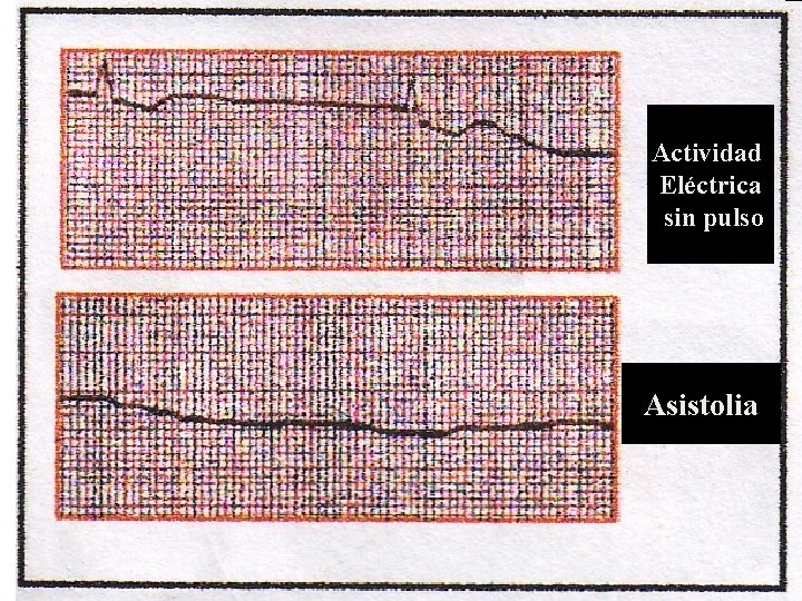 Actividad Eléctrica sin pulso Asistolia 