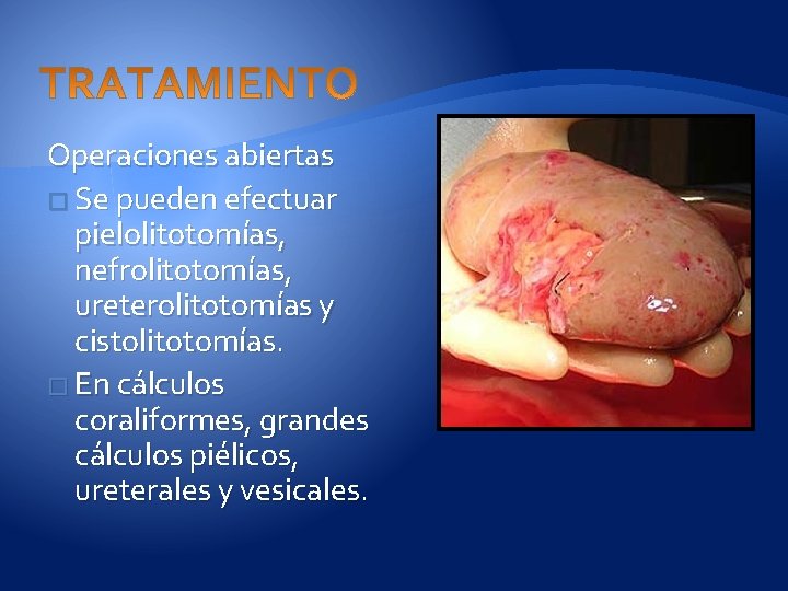 Operaciones abiertas � Se pueden efectuar pielolitotomías, nefrolitotomías, ureterolitotomías y cistolitotomías. � En cálculos