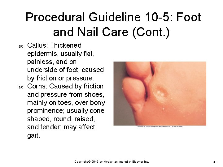 Procedural Guideline 10 -5: Foot and Nail Care (Cont. ) Callus: Thickened epidermis, usually