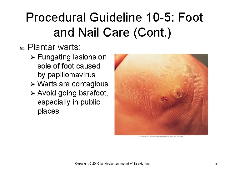 Procedural Guideline 10 -5: Foot and Nail Care (Cont. ) Plantar warts: Fungating lesions