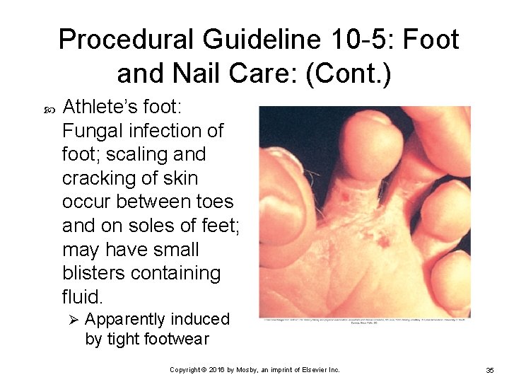 Procedural Guideline 10 -5: Foot and Nail Care: (Cont. ) Athlete’s foot: Fungal infection
