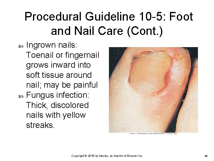 Procedural Guideline 10 -5: Foot and Nail Care (Cont. ) Ingrown nails: Toenail or