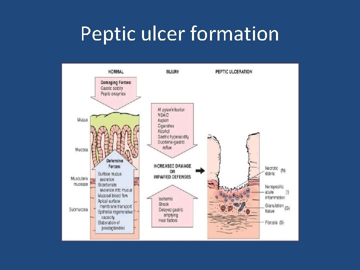 Peptic ulcer formation 