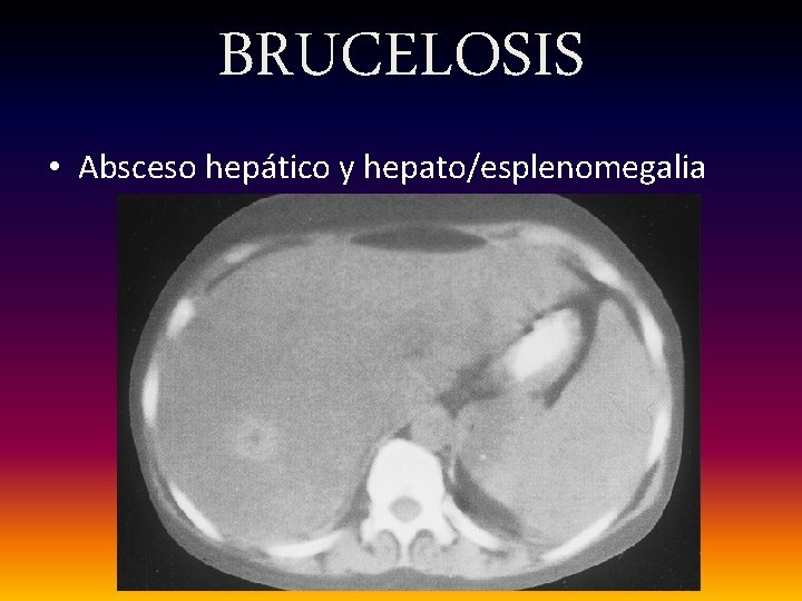 BRUCELOSIS • Absceso hepático y hepato/esplenomegalia 