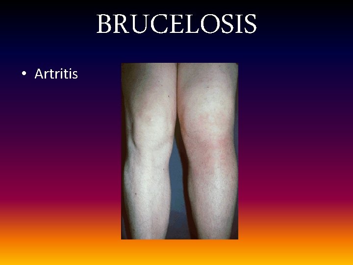 BRUCELOSIS • Artritis 