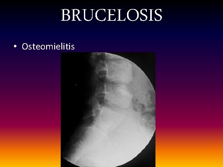 BRUCELOSIS • Osteomielitis 