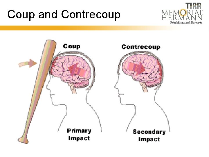 Coup and Contrecoup 