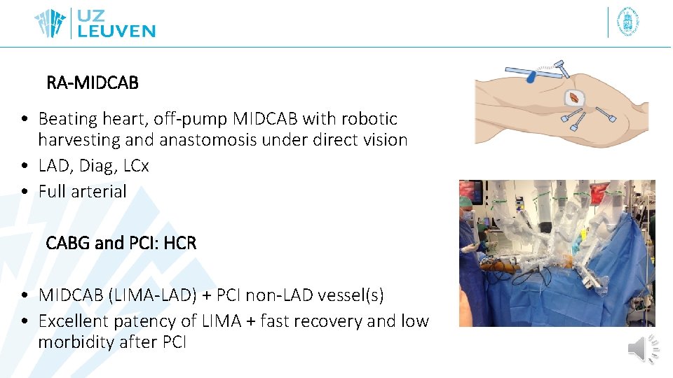 RA-MIDCAB • Beating heart, off-pump MIDCAB with robotic harvesting and anastomosis under direct vision