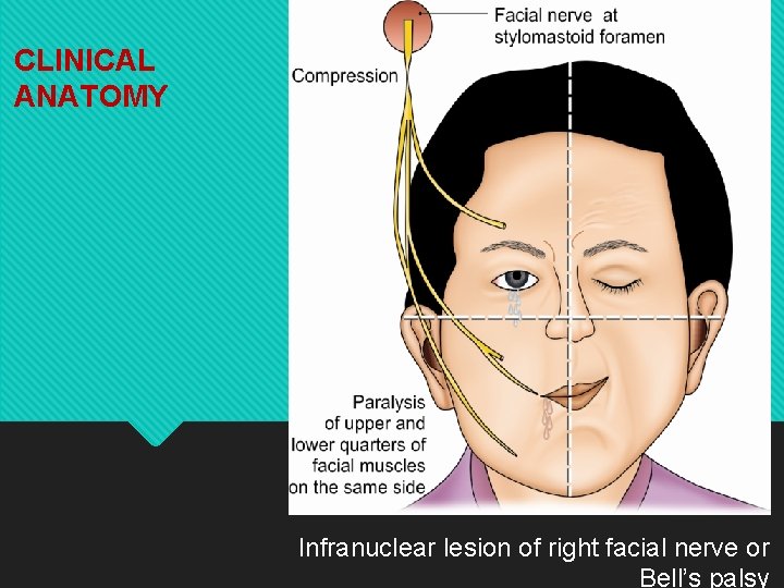 CLINICAL ANATOMY Infranuclear lesion of right facial nerve or Bell’s palsy 