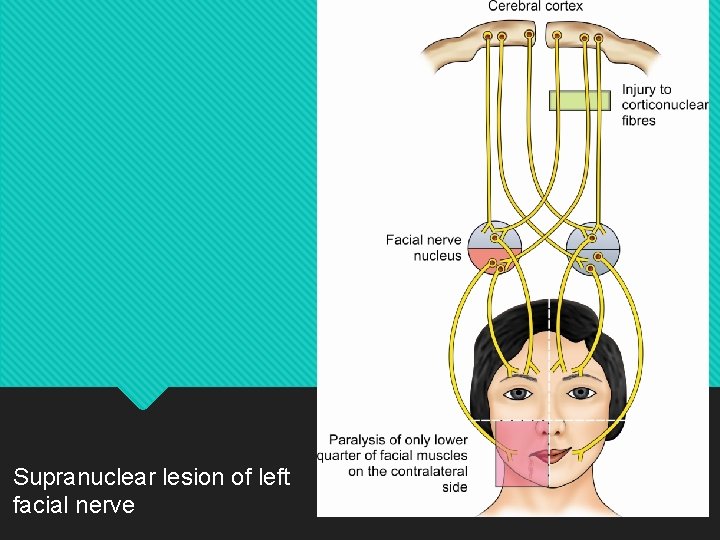 Supranuclear lesion of left facial nerve 