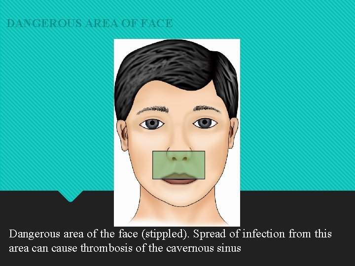 DANGEROUS AREA OF FACE Dangerous area of the face (stippled). Spread of infection from
