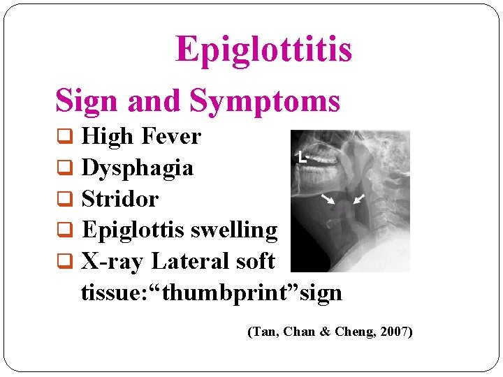 Epiglottitis Sign and Symptoms q High Fever q Dysphagia q Stridor q Epiglottis swelling