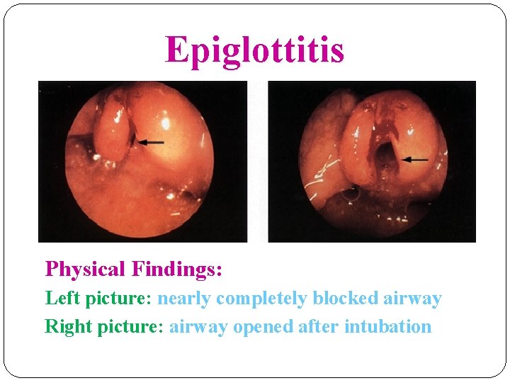 Epiglottitis Physical Findings: Left picture: nearly completely blocked airway Right picture: airway opened after