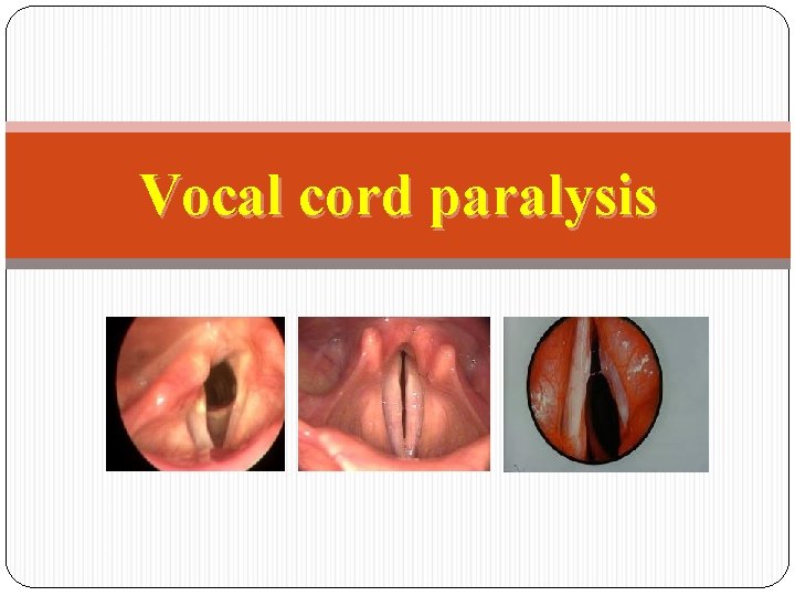 Vocal cord paralysis 