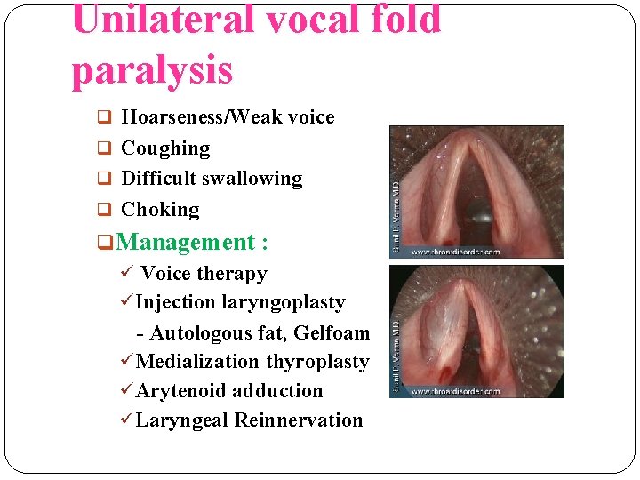 Unilateral vocal fold paralysis q Hoarseness/Weak voice q Coughing q Difficult swallowing q Choking