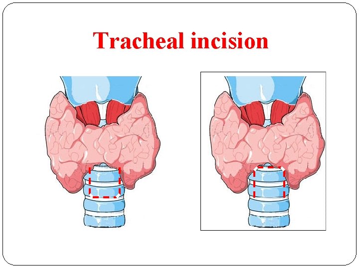 Tracheal incision 