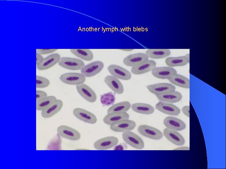Another lymph with blebs 