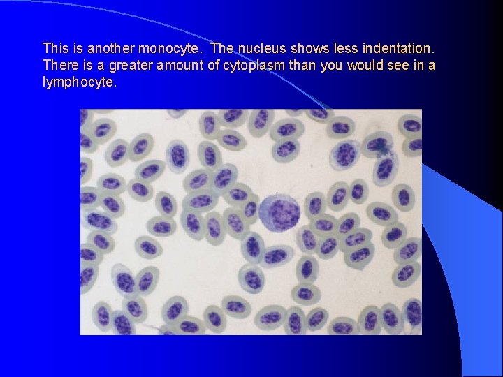 This is another monocyte. The nucleus shows less indentation. There is a greater amount