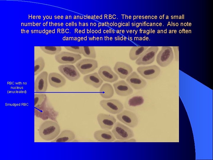 Here you see an anucleated RBC. The presence of a small number of these