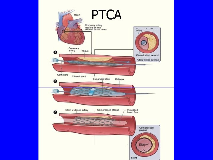 PTCA 